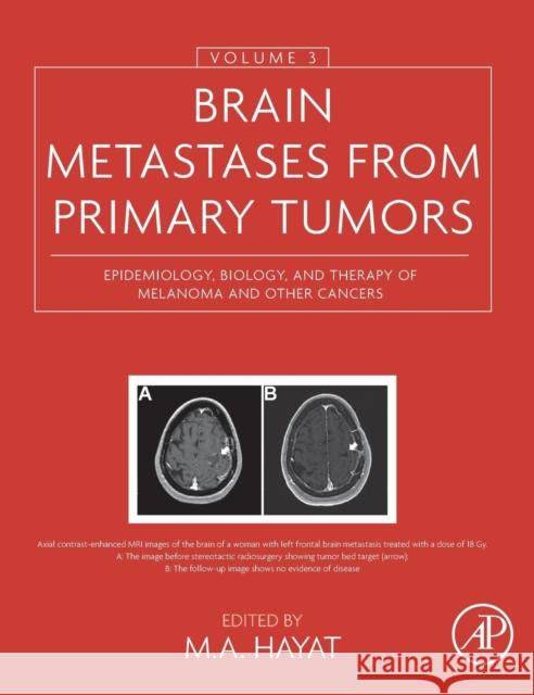 Brain Metastases from Primary Tumors, Volume 3: Epidemiology, Biology, and Therapy of Melanoma and Other Cancers M. Hayat 9780128035085 ACADEMIC PRESS - książka