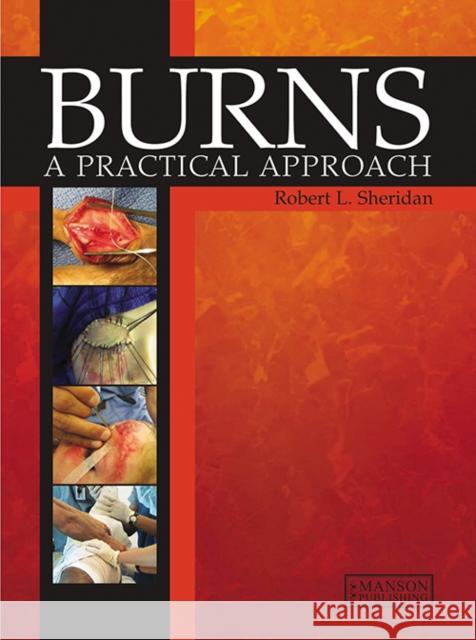 Burns: A Practical Approach to Immediate Treatment and Long Term Care Sheridan, Robert 9781626237032 Thieme Medical Publishers Inc - książka