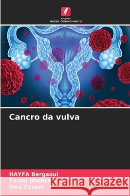 Cancro da vulva Hayfa Bergaoui Toumi Dhekra Ines Zouari 9786207600274 Edicoes Nosso Conhecimento - książka