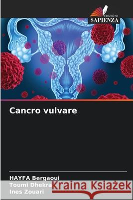 Cancro vulvare Hayfa Bergaoui Toumi Dhekra Ines Zouari 9786207600267 Edizioni Sapienza - książka