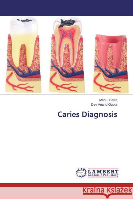 Caries Diagnosis Batra, Manu; Gupta, Dev Anand 9783659467981 LAP Lambert Academic Publishing - książka