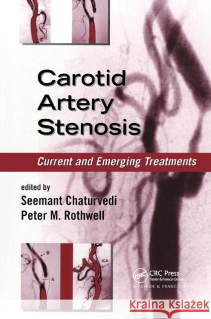 Carotid Artery Stenosis: Current and Emerging Treatments Seemant Chaturvedi Peter M. Rothwell 9780367392406 CRC Press - książka