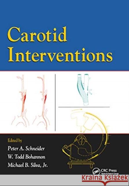 Carotid Interventions Peter Schneider Todd Bohannon Michael Silva 9780367454333 CRC Press - książka
