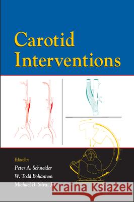 Carotid Interventions Schneider                                Peter A. Schneider W. Todd Bohannon 9780824759322 Informa Healthcare - książka