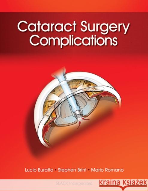 Cataract Surgery Complications Lucio Buratto Stephen Brint Mario Romano 9781617116087 Slack - książka