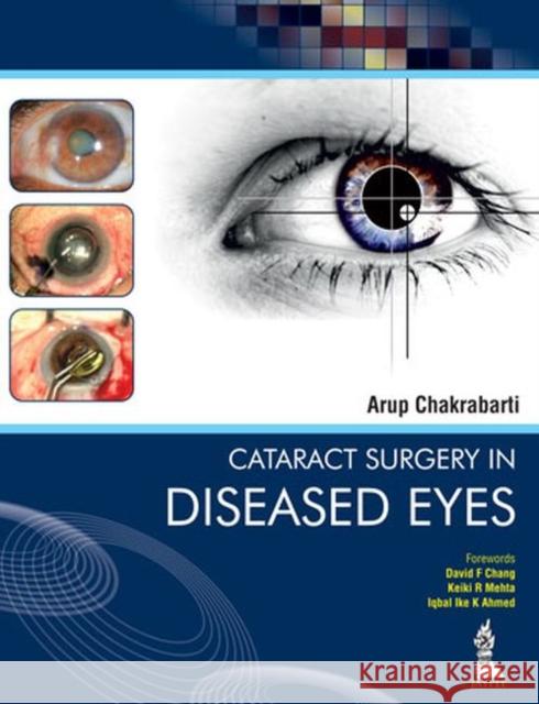 Cataract Surgery in Diseased Eyes Arup Chakrabarti   9789351520924 Jaypee Brothers Medical Publishers - książka