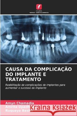 Causa Da Complicacao Do Implante E Tratamento Amyn Chamadia Amrita Upadhyay Ruquaya Bashir 9786206013433 Edicoes Nosso Conhecimento - książka