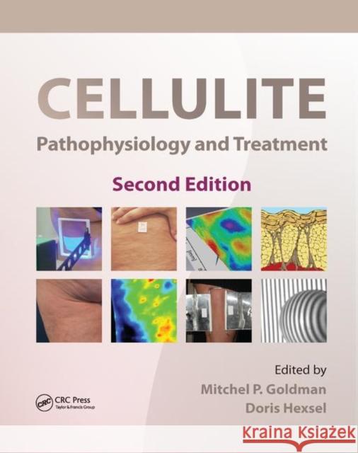 Cellulite: Pathophysiology and Treatment Mitchel P. Goldman Doris Hexsel 9780367384180 CRC Press - książka