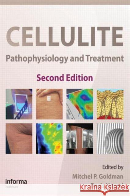 Cellulite: Pathophysiology and Treatment Goldman, Mitchel P. 9781439802717 Informa Healthcare - książka