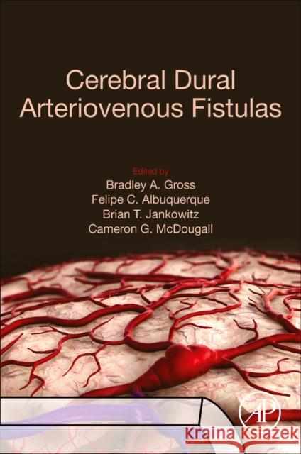 Cerebral Dural Arteriovenous Fistulas Bradley A. Gross Felipe C. Albuquerque Brian T. Jankowitz 9780128195253 Academic Press - książka