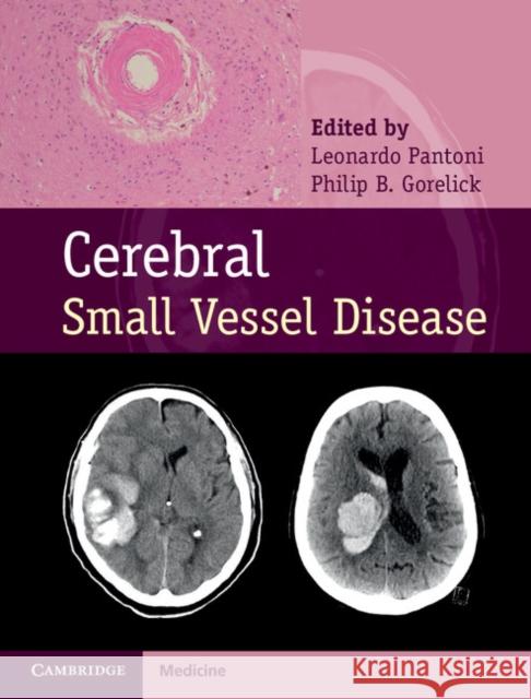 Cerebral Small Vessel Disease Leonardo Pantoni Philip B. Gorelick  9781107031661 Cambridge University Press - książka