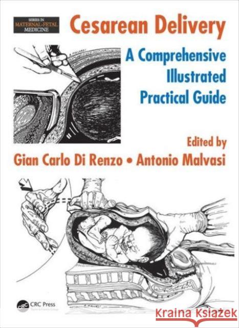 Cesarean Delivery: A Comprehensive Illustrated Practical Guide Gian Carlo D Antonio Malvasi 9781482226331 CRC Press - książka