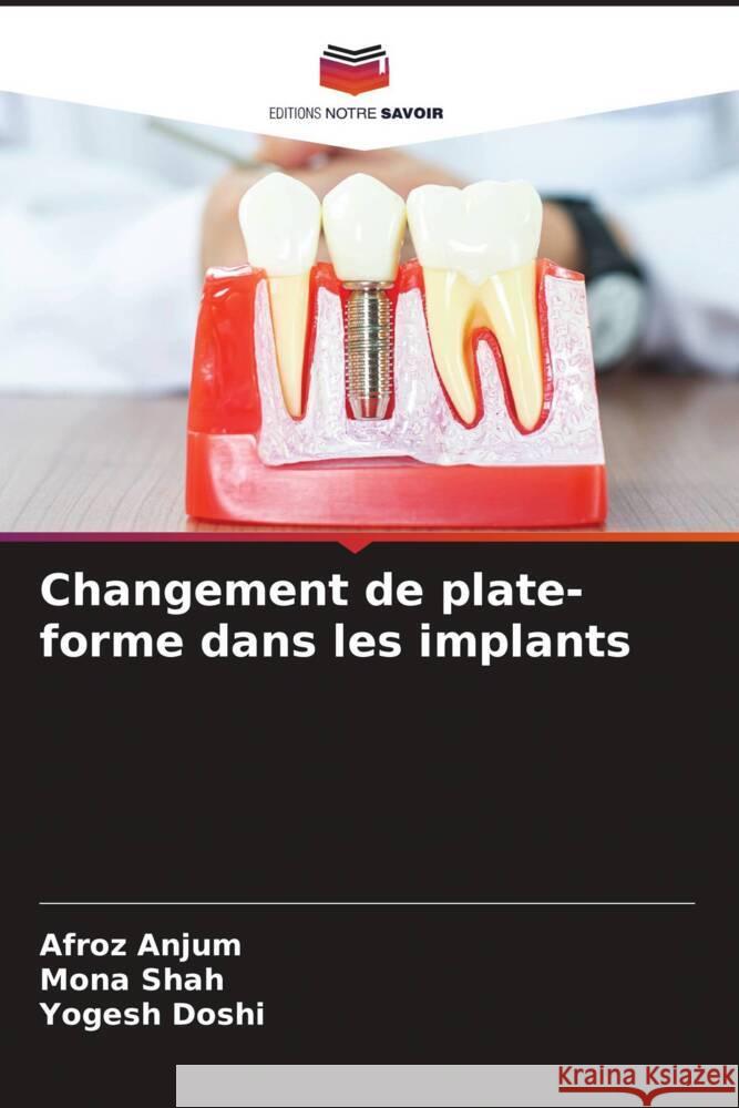 Changement de plate-forme dans les implants Anjum, Afroz, Shah, Mona, Doshi, Yogesh 9786205164075 Editions Notre Savoir - książka