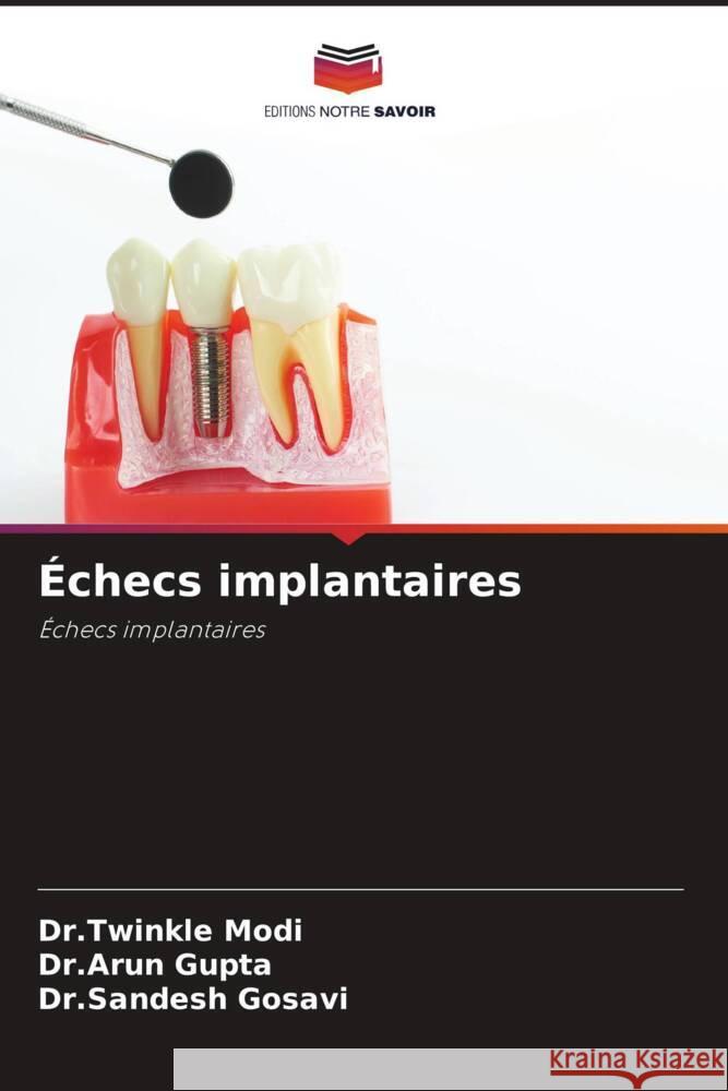 ?checs implantaires Dr Twinkle Modi Dr Arun Gupta Dr Sandesh Gosavi 9786207430604 Editions Notre Savoir - książka