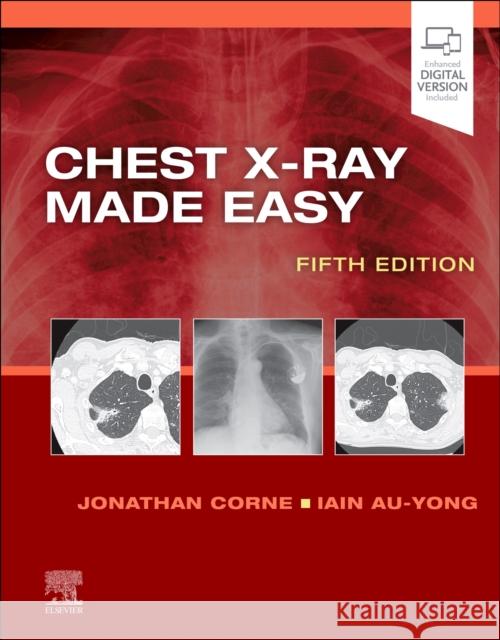Chest X-Ray Made Easy Iain (Consultant Thoracic, Head and Neck and General Radiologist at Nottingham University Hospitals, , Nottingham, UK) A 9780702082344 Elsevier Health Sciences - książka