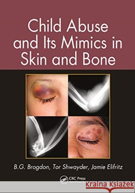 Child Abuse and Its Mimics in Skin and Bone Brogdon, B. G. 9780367778187 Taylor and Francis - książka