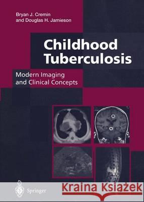 Childhood Tuberculosis: Modern Imaging and Clinical Concepts Bryan J. Cremin Douglas H. Jamieson 9781447130130 Springer - książka