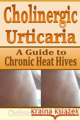 Cholinergic Urticaria: A Guide to Chronic Heat Hives B. Page 9781497387898 Createspace - książka