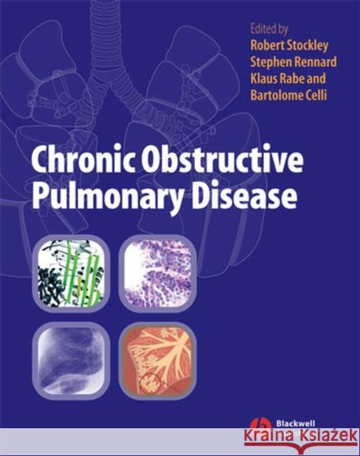 Chronic Obstructive Pulmonary Disease Steve Rennard Robert Stockley Bartolome Celli 9781405122894 Blackwell Publishers - książka