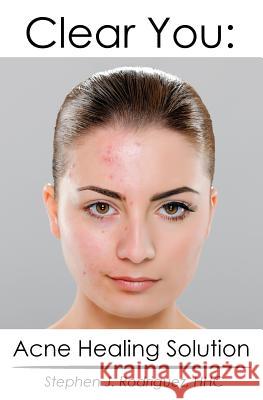 Clear You: Acne Healing Solution Stephen J. Rodrigue 9781500768836 Createspace - książka
