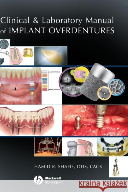 Clinical and Laboratory Manual of Implant Overdentures Hamid Shafie 9780813808819 Blackwell Publishing Professional - książka