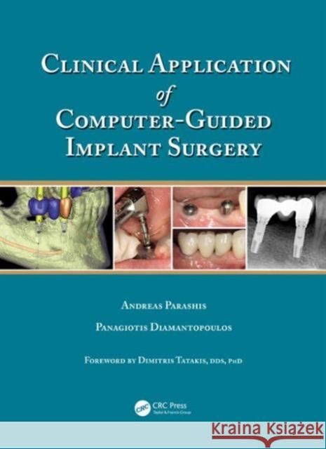 Clinical Application of Computer-Guided Implant Surgery Panagiotis Diamantopoulos Andreas Parashis 9781482205411 CRC Press - książka
