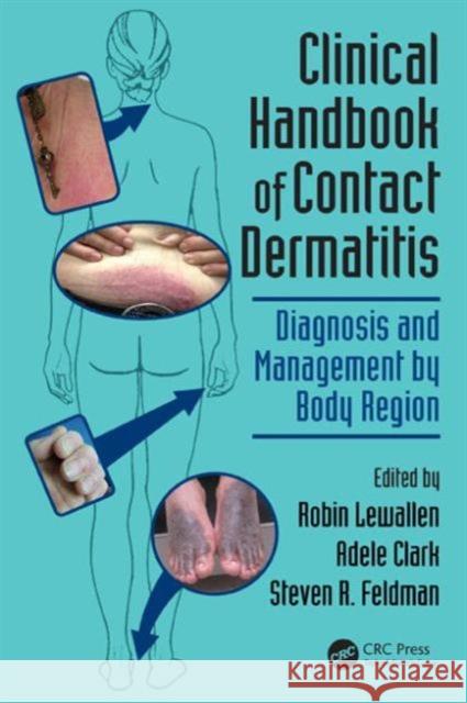 Clinical Handbook of Contact Dermatitis: Diagnosis and Management by Body Region Robin Lewallen Adele Clark Steven R. Feldman 9781482237177 CRC Press - książka