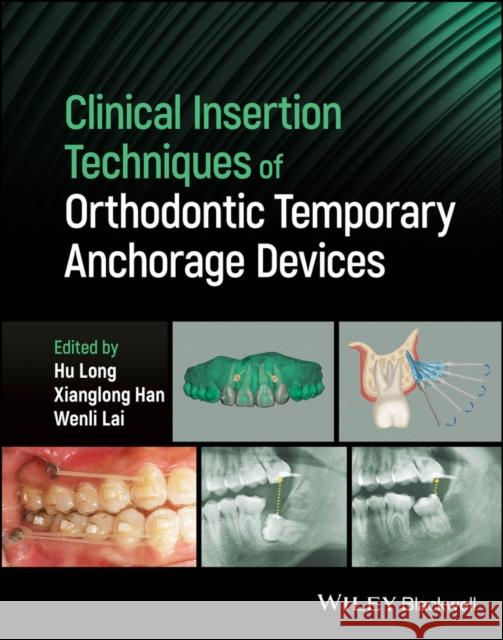 Clinical Insertion Techniques of Orthodontic Tempo rary Anchorage Devices H Long 9781119892236 John Wiley and Sons Ltd - książka
