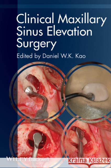 Clinical Maxillary Sinus Elevation Surgery  9780470960738 John Wiley & Sons - książka