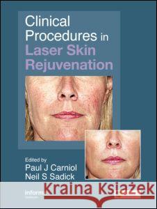 Clinical Procedures in Laser Skin Rejuvenation Paul Carniol Neil S. Sadick 9780415414135 Informa Healthcare - książka