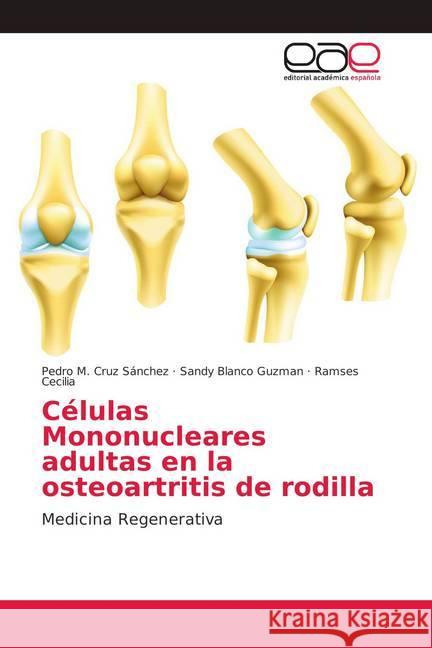 Células Mononucleares adultas en la osteoartritis de rodilla : Medicina Regenerativa Cruz Sánchez, Pedro M.; Blanco Guzman, Sandy; Cecilia, Ramses 9786202155731 Editorial Académica Española - książka