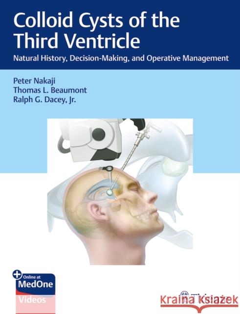 Colloid Cysts of the Third Ventricle: Natural History, Decision-Making, and Operative Management Peter Nakaji Thomas Beaumont Ralph Dace 9781684201563 Thieme Medical Publishers - książka