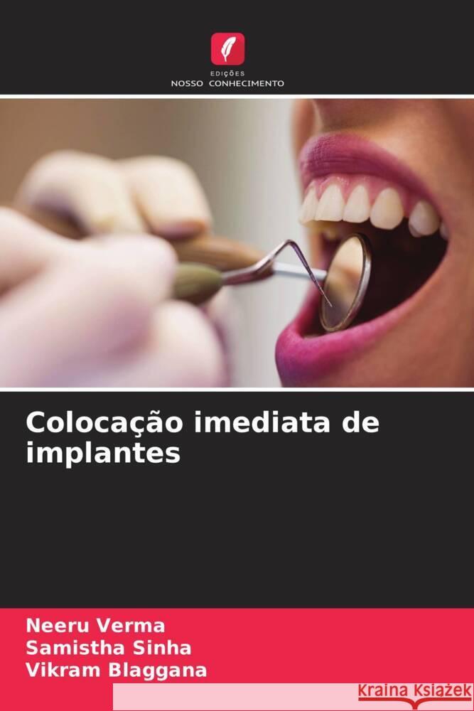 Coloca??o imediata de implantes Neeru Verma Samistha Sinha Vikram Blaggana 9786206546610 Edicoes Nosso Conhecimento - książka