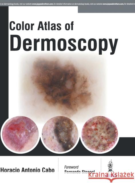Color Atlas of Dermoscopy Horacio Cabo 9789386056306 Jaypee Brothers, Medical Publishers Pvt. Ltd. - książka