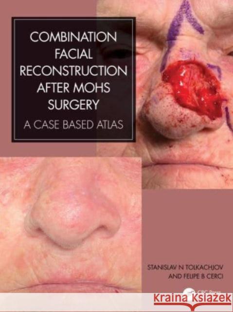 Combination Facial Reconstruction after Mohs Surgery: A Case Based Atlas Stanislav N. Tolkachjov Felipe B. Cerci 9780367903183 Taylor & Francis Ltd - książka