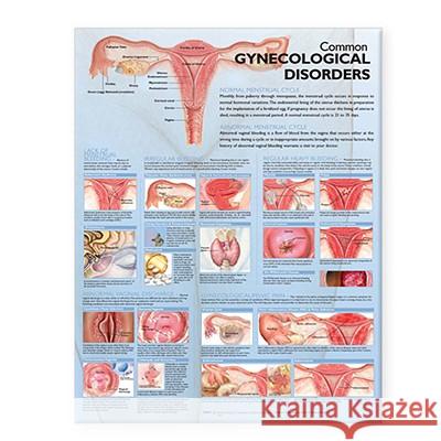 Common Gynecological Disorders Anatomical Chart Anatomical Chart Company 9780781773515 Lippincott Williams & Wilkins - książka