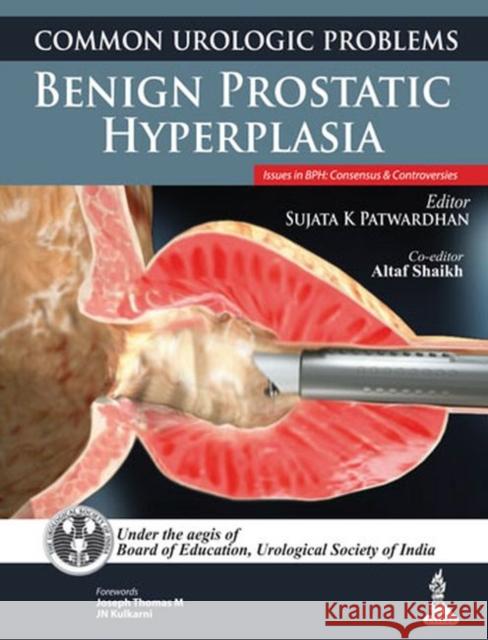 Common Urologic Problems: Benign Prostatic Hyperplasia Sujata Patwardhan 9789350908419 Jp Medical Ltd - książka