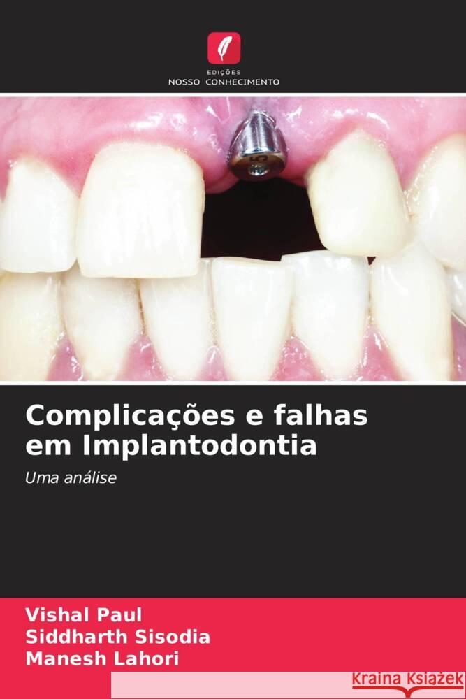 Complica??es e falhas em Implantodontia Vishal Paul Siddharth Sisodia Manesh Lahori 9786206907404 Edicoes Nosso Conhecimento - książka