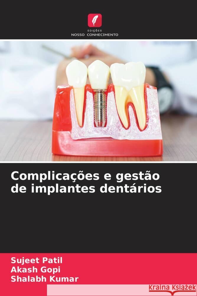 Complica??es e gest?o de implantes dent?rios Sujeet Patil Akash Gopi Shalabh Kumar 9786207225569 Edicoes Nosso Conhecimento - książka