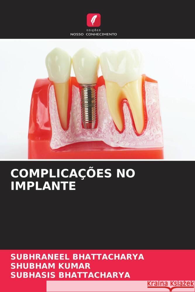 COMPLICAÇÕES NO IMPLANTE BHATTACHARYA, SUBHRANEEL, Kumar, Shubham, Bhattacharya, Subhasis 9786208198978 Edições Nosso Conhecimento - książka