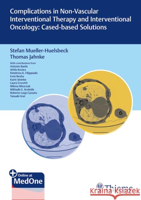 Complications in Non-Vascular Interventional Therapy and Interventional Oncology: Case-Based Solutions Müller-Hülsbeck, Stefan 9783132412873 Thieme, Stuttgart - książka