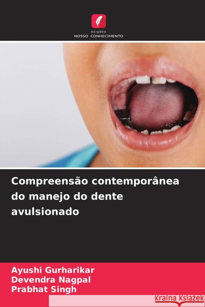 Compreensão contemporânea do manejo do dente avulsionado Gurharikar, Ayushi, Nagpal, Devendra, Singh, Prabhat 9786202739542 Edições Nosso Conhecimento - książka