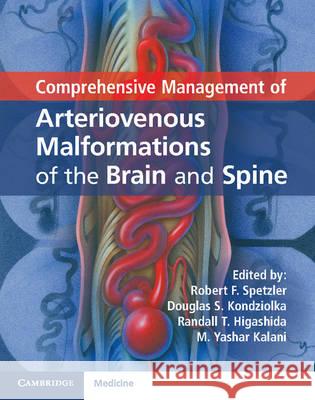 Comprehensive Management of Arteriovenous Malformations of the Brain and Spine Robert Spetzler Douglas S. Kondziolka Randall T. Higashida 9781107033887 Cambridge University Press - książka