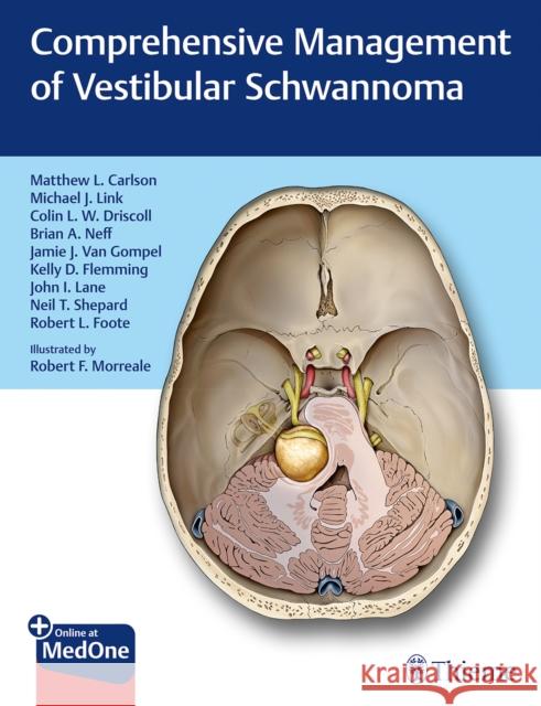 Comprehensive Management of Vestibular Schwannoma Carlson, Matthew L. 9781626233317 Thieme Medical Publishers - książka