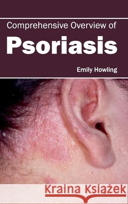 Comprehensive Overview of Psoriasis Emily Howling 9781632420893 Foster Academics - książka