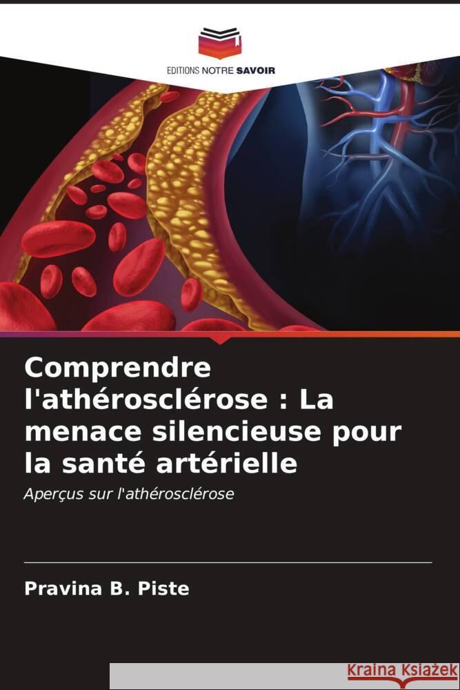 Comprendre l'ath?roscl?rose: La menace silencieuse pour la sant? art?rielle Pravina B. Piste 9786207012770 Editions Notre Savoir - książka