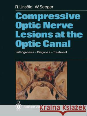 Compressive Optic Nerve Lesions at the Optic Canal: Pathogenesis - Diagnosis - Treatment Unsöld, Renate 9783642733840 Springer - książka