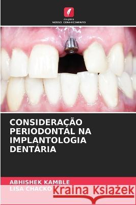 Consideracao Periodontal Na Implantologia Dentaria Abhishek Kamble Lisa Chacko  9786205888209 Edicoes Nosso Conhecimento - książka