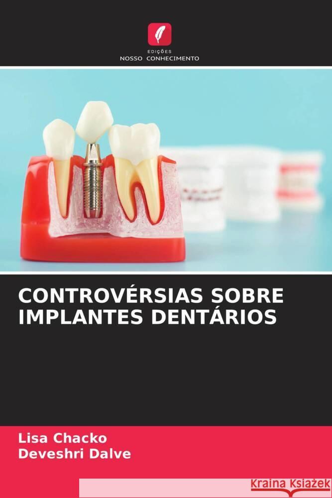 Controversias Sobre Implantes Dentarios Lisa Chacko Deveshri Dalve  9786205976838 Edicoes Nosso Conhecimento - książka