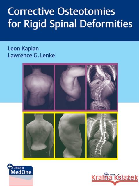 Corrective Osteotomies for Rigid Spinal Deformities Leon Kaplan Lawrence G. Lenke  9783131730817 Thieme Publishing Group - książka